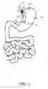 Fig. 02 - Medical Device and Method For Controlling Obesity