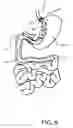 Fig. 06 - Medical Device and Method For Controlling Obesity