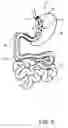 Fig. 07 - Medical Device and Method For Controlling Obesity