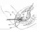 Fig. 01 - Vaginal spring loaded delineator