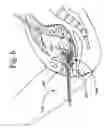 Fig. 07 - Vaginal spring loaded delineator