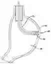 Fig. 01 - Device for plicating and fastening gastric tissue