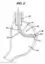 Fig. 03 - Device for plicating and fastening gastric tissue