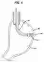 Fig. 05 - Device for plicating and fastening gastric tissue