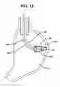 Fig. 12 - Device for plicating and fastening gastric tissue