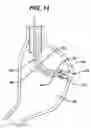 Fig. 13 - Device for plicating and fastening gastric tissue