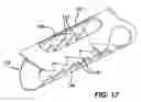 Fig. 16 - Device for plicating and fastening gastric tissue