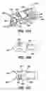 Fig. 18 - Device for plicating and fastening gastric tissue