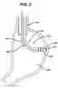 Fig. 03 - Device for plicating and fastening gastric tissue