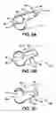 Fig. 04 - Device for plicating and fastening gastric tissue