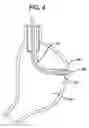 Fig. 05 - Device for plicating and fastening gastric tissue