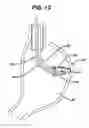 Fig. 12 - Device for plicating and fastening gastric tissue