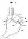Fig. 13 - Device for plicating and fastening gastric tissue