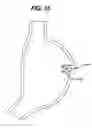 Fig. 14 - Device for plicating and fastening gastric tissue