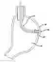 Fig. 01 - Device for plicating and fastening gastric tissue