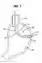 Fig. 03 - Device for plicating and fastening gastric tissue