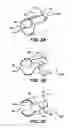 Fig. 04 - Device for plicating and fastening gastric tissue