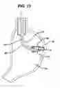 Fig. 12 - Device for plicating and fastening gastric tissue