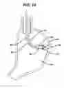 Fig. 13 - Device for plicating and fastening gastric tissue