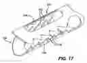 Fig. 16 - Device for plicating and fastening gastric tissue