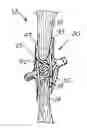 Fig. 01 - Septal closure device with centering mechanism