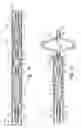 Fig. 05 - Septal closure device with centering mechanism