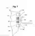 Fig. 06 - Method and apparatus for tissue fastening
