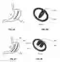 Fig. 04 - Methods for reducing gastric volume