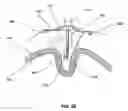 Fig. 09 - Methods for reducing gastric volume