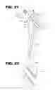Fig. 13 - Methods and Instruments of Reducing a Fracture