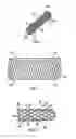 Fig. 02 - Covered stents with degradable barbs
