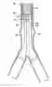 Fig. 01 - Stent/Graft Assembly
