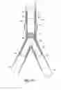 Fig. 10 - Stent/Graft Assembly