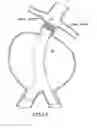 Fig. 12 - Stent/Graft Assembly
