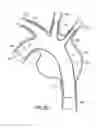 Fig. 15 - Stent/Graft Assembly