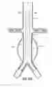 Fig. 18 - Stent/Graft Assembly