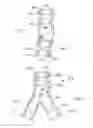 Fig. 34 - Stent/Graft Assembly