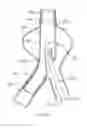 Fig. 36 - Stent/Graft Assembly