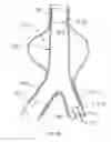 Fig. 37 - Stent/Graft Assembly