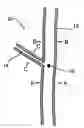 Fig. 01 - Bifurcated Stent Assembly