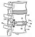 Fig. 01 - Implant restraint device and methods