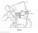 Fig. 22 - Implant restraint device and methods