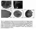 Fig. 04 - Method for the production of intervertebral disk cell transplants and their use as transplantation material