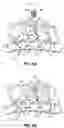 Fig. 05 - Prosthetic Disc Device and Method for Intervertebral Disc Replacement