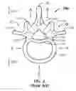 Fig. 04 - Vertebral defect device
