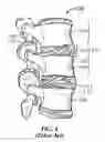 Fig. 05 - Vertebral defect device