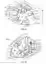 Fig. 13 - Vertebral defect device