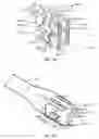 Fig. 14 - Vertebral defect device