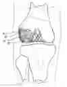 Fig. 01 - Stable cartilage defect repair plug