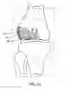 Fig. 04 - Stable cartilage defect repair plug